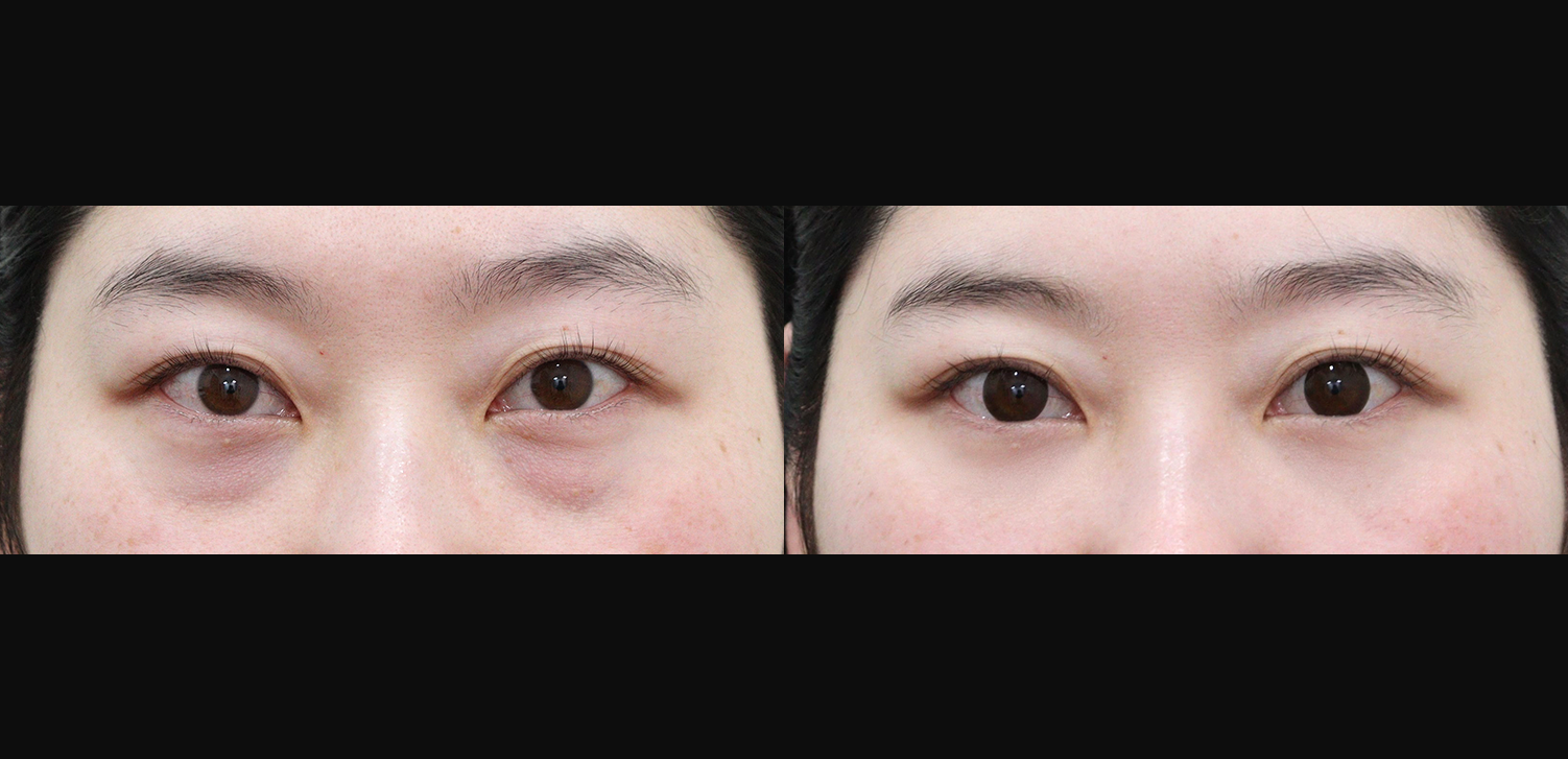 눈밑지방재배치+지방이식(앞광대)