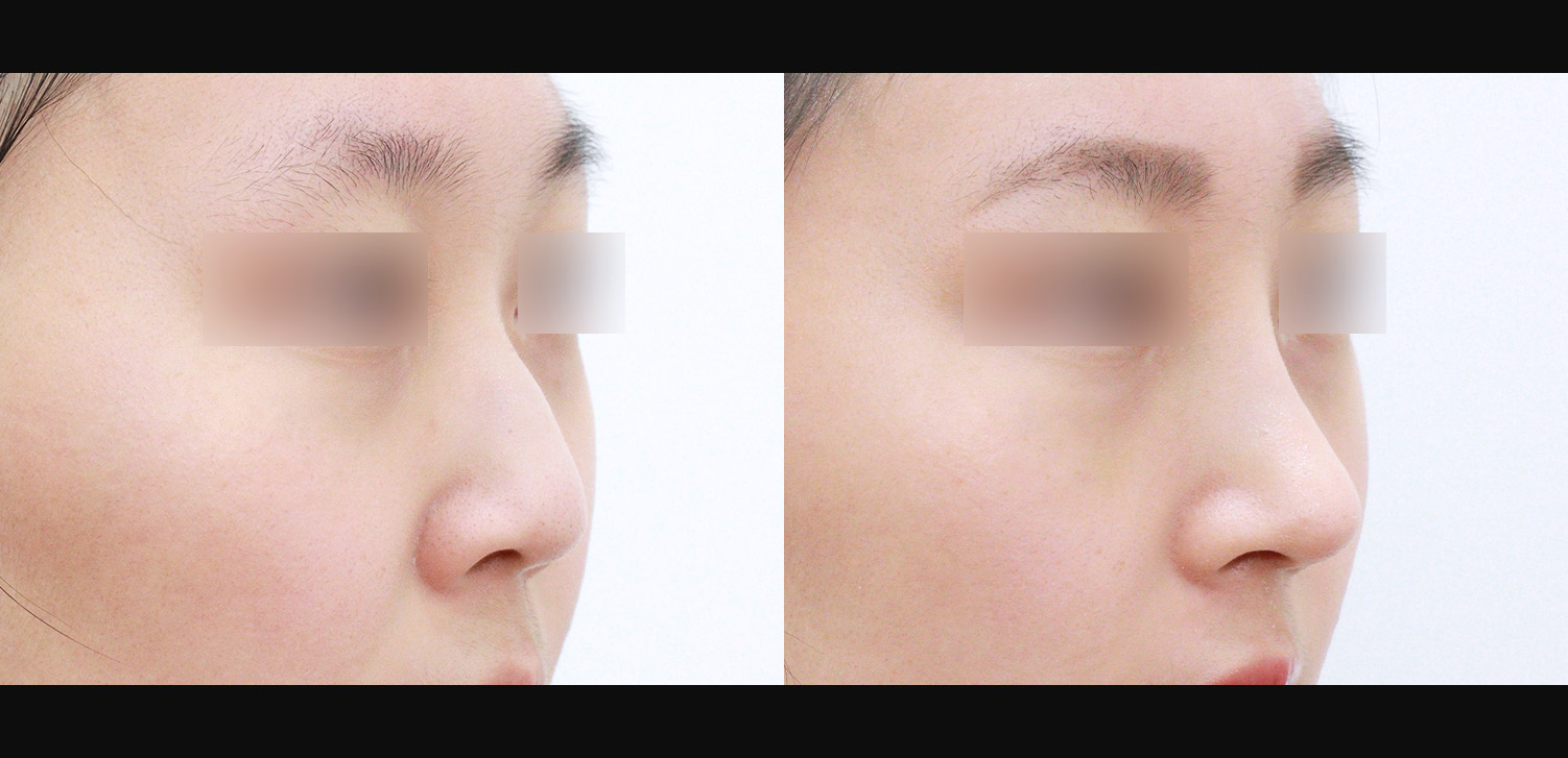 3D코성형(들창코+복코+인중코)