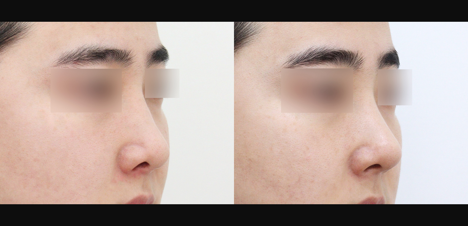 코재수술(늑연골+들창코+휜코+비중격재건+기능코)