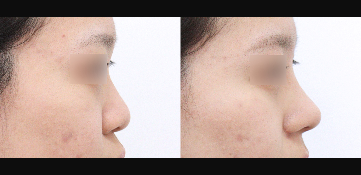 3D코성형(자늑+복코+인중코+콧볼축소)