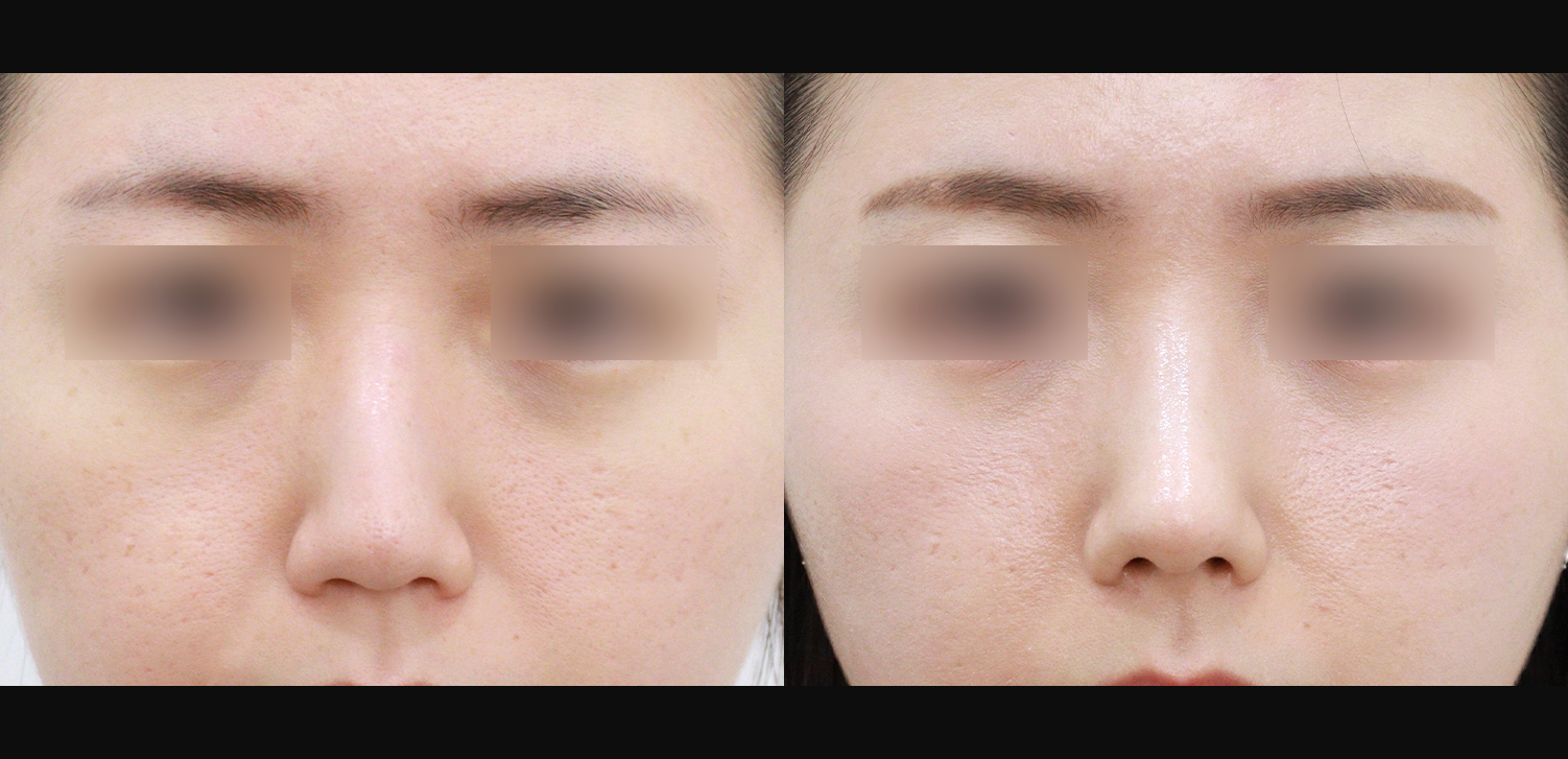코끝+매부리+인중코+기능코