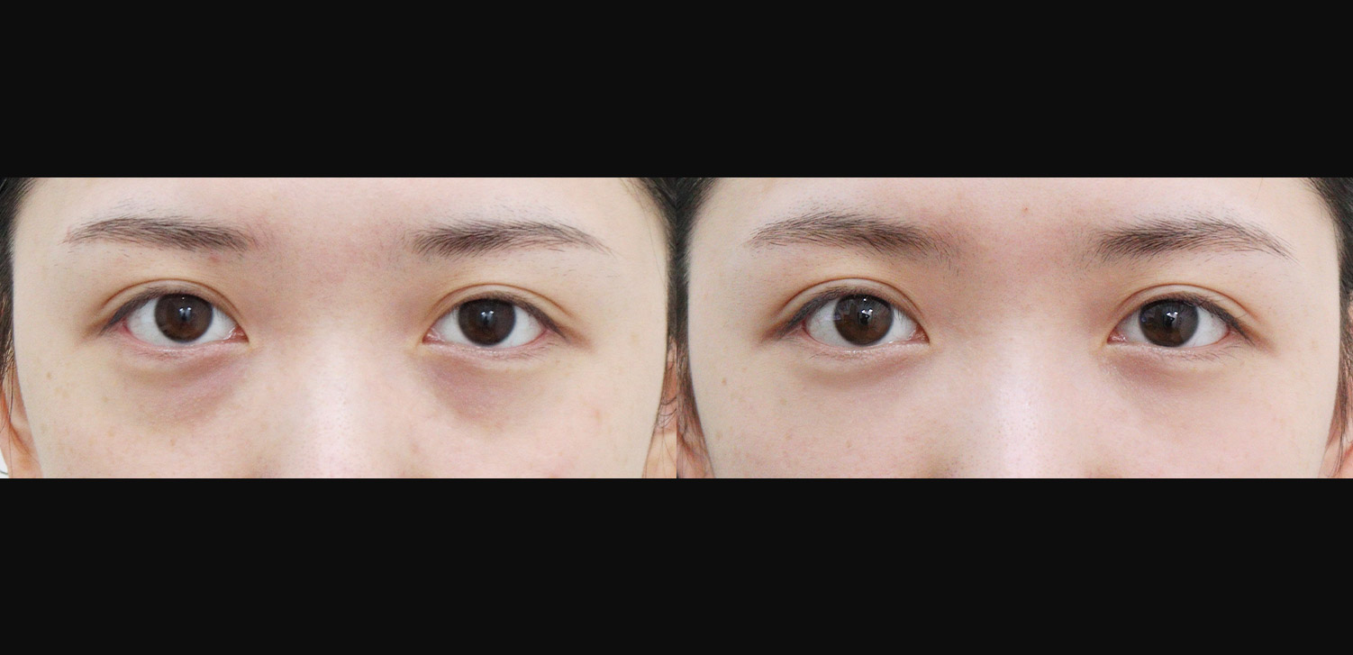 눈밑지방재배치+지방이식(앞광대)