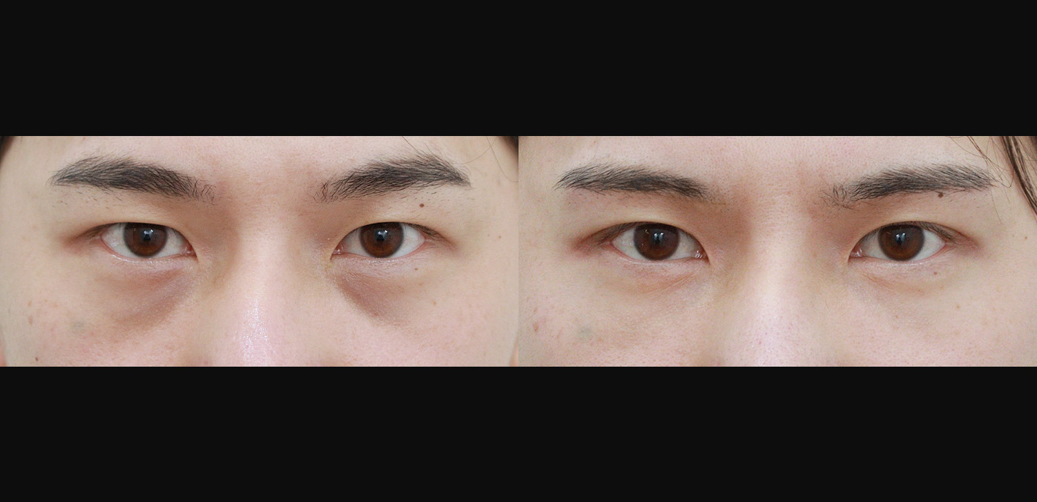 눈밑지방재배치+눈썹하거상술
