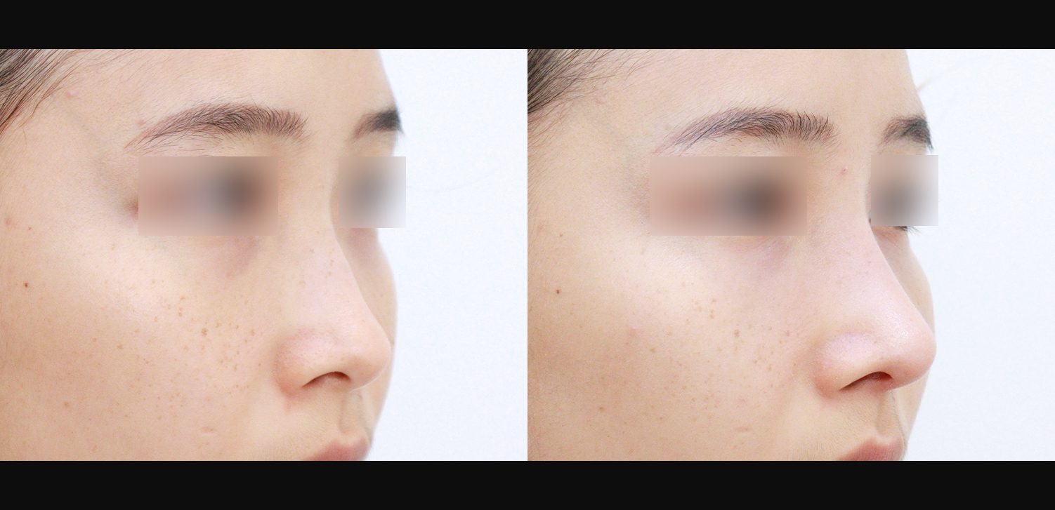 3D 코성형(콧대+코끝+들창코+인중코)