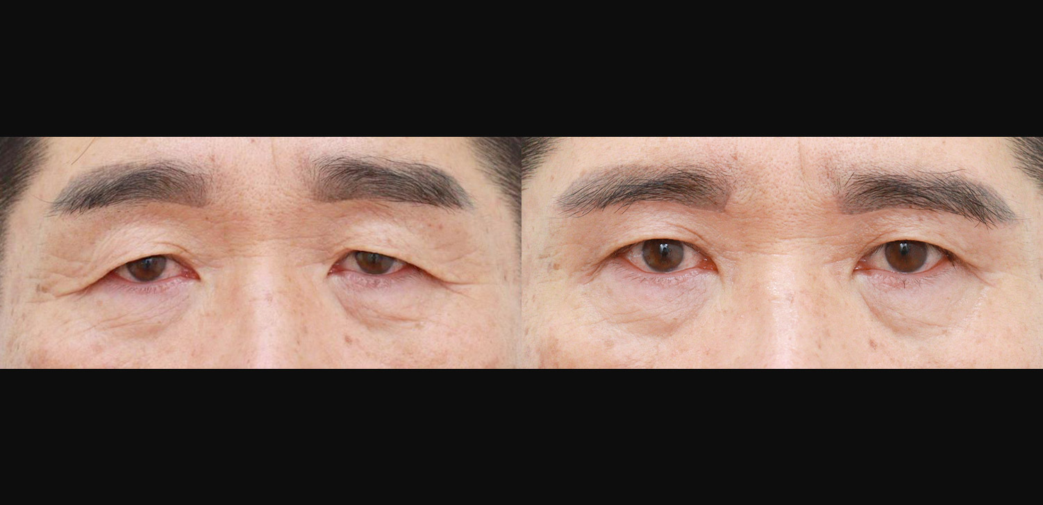 눈썹하거상술