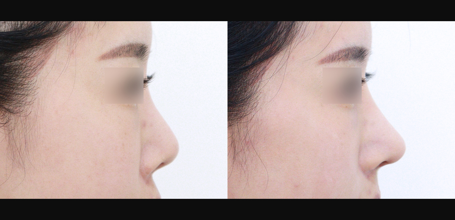 3D 코성형 재수술(콧대+코끝+들창코+인중코)