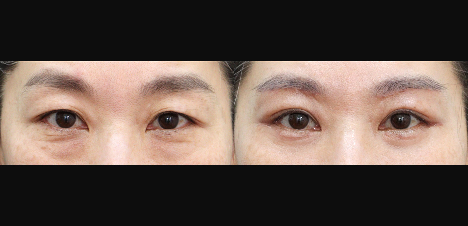 하안검+눈썹하거상술+외안각고정술