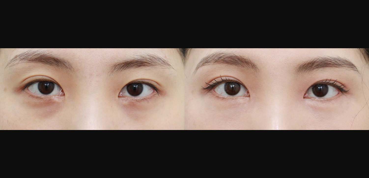 눈밑지방재배치