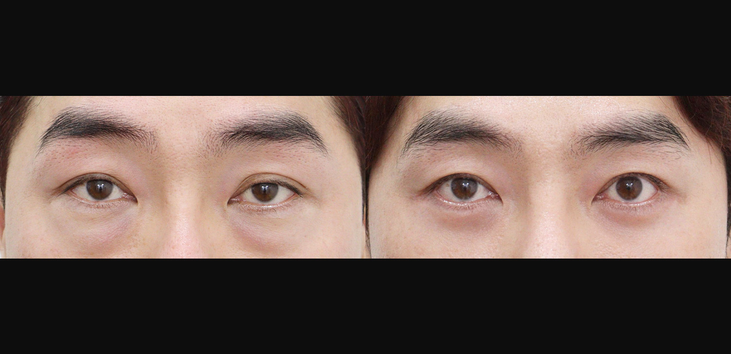 절개 쌍꺼풀+눈매교정+하안검+외안각고정술