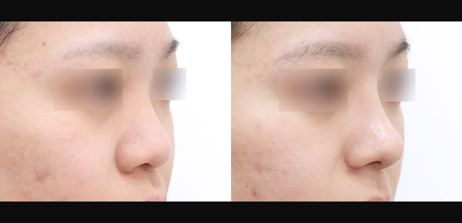 3D코성형(자늑+복코+인중코+콧볼축소)