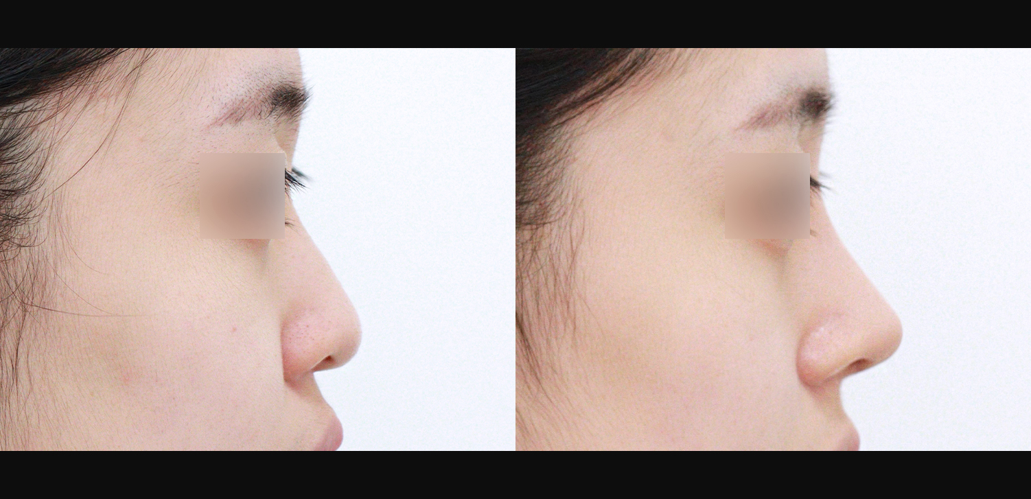 3D 코성형(복코+매부리코+인중코)