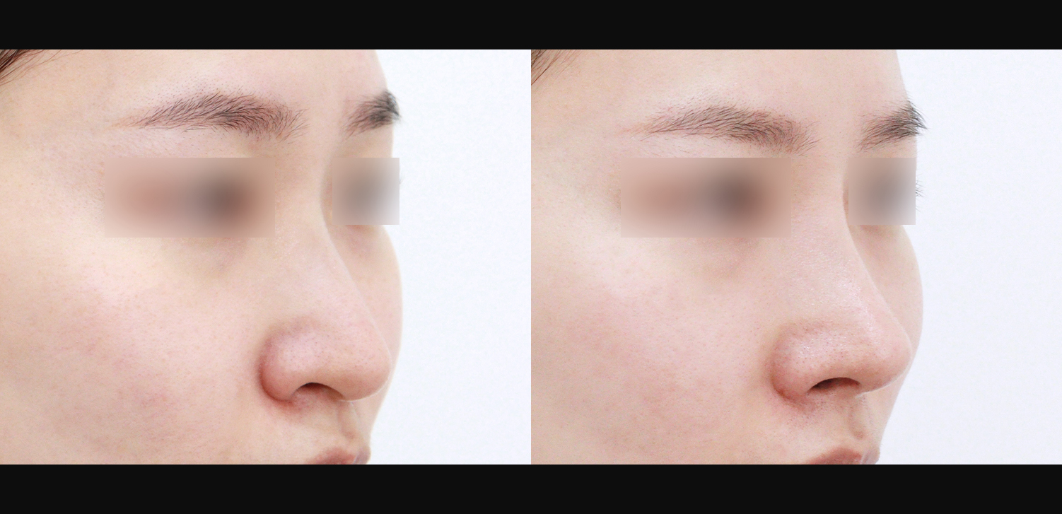 3D 코성형(콧대+코끝+화살코+콧볼축소+인중코+기능코)