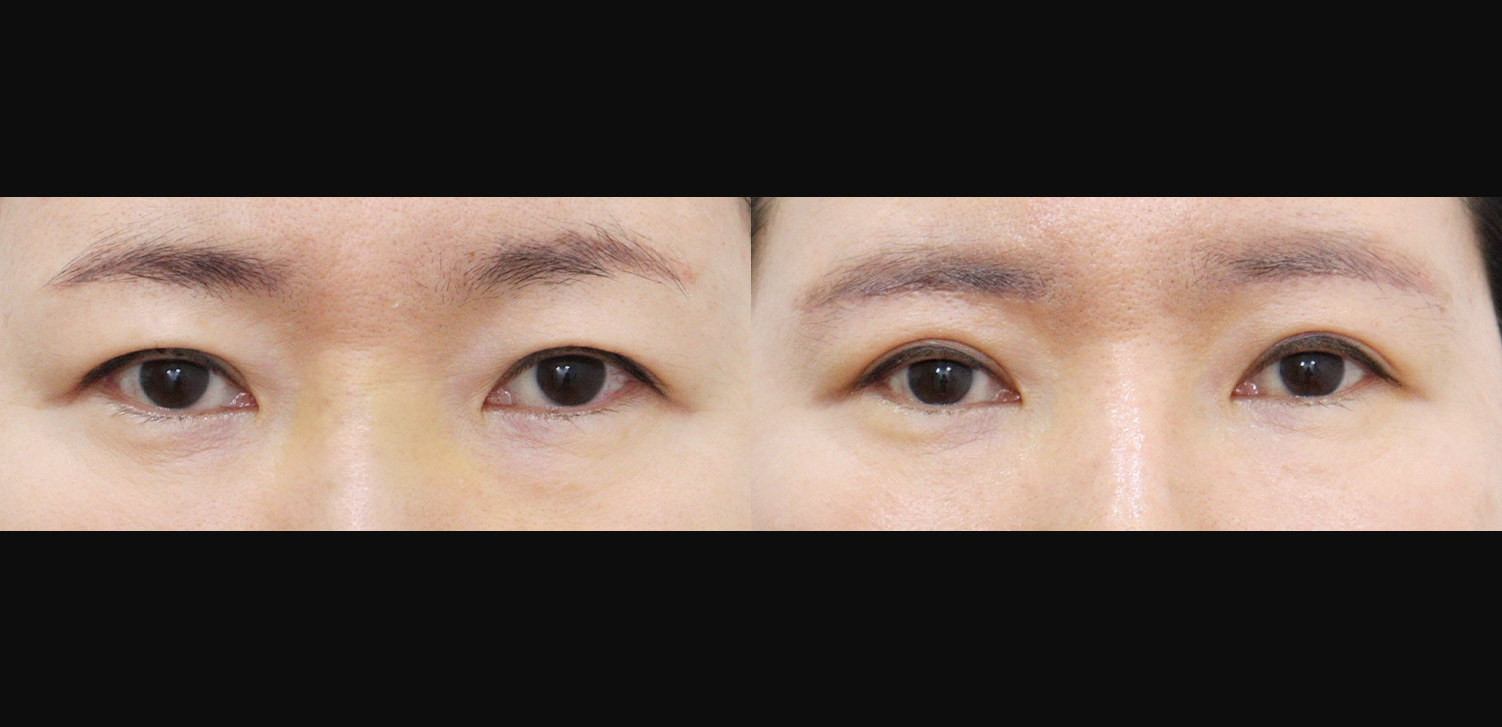 눈썹하거상술+지방 제거