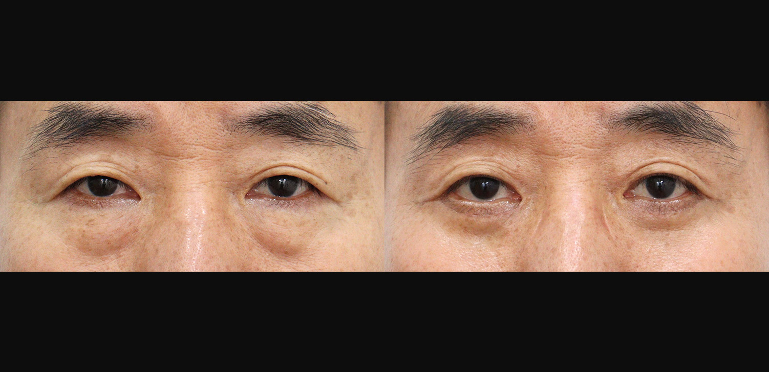 하안검+외안각고정