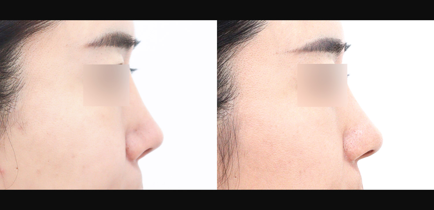 3D코성형 재수술(자가늑+콧대+코끝+복코+들창코+찝힌코+인중코+기능코)