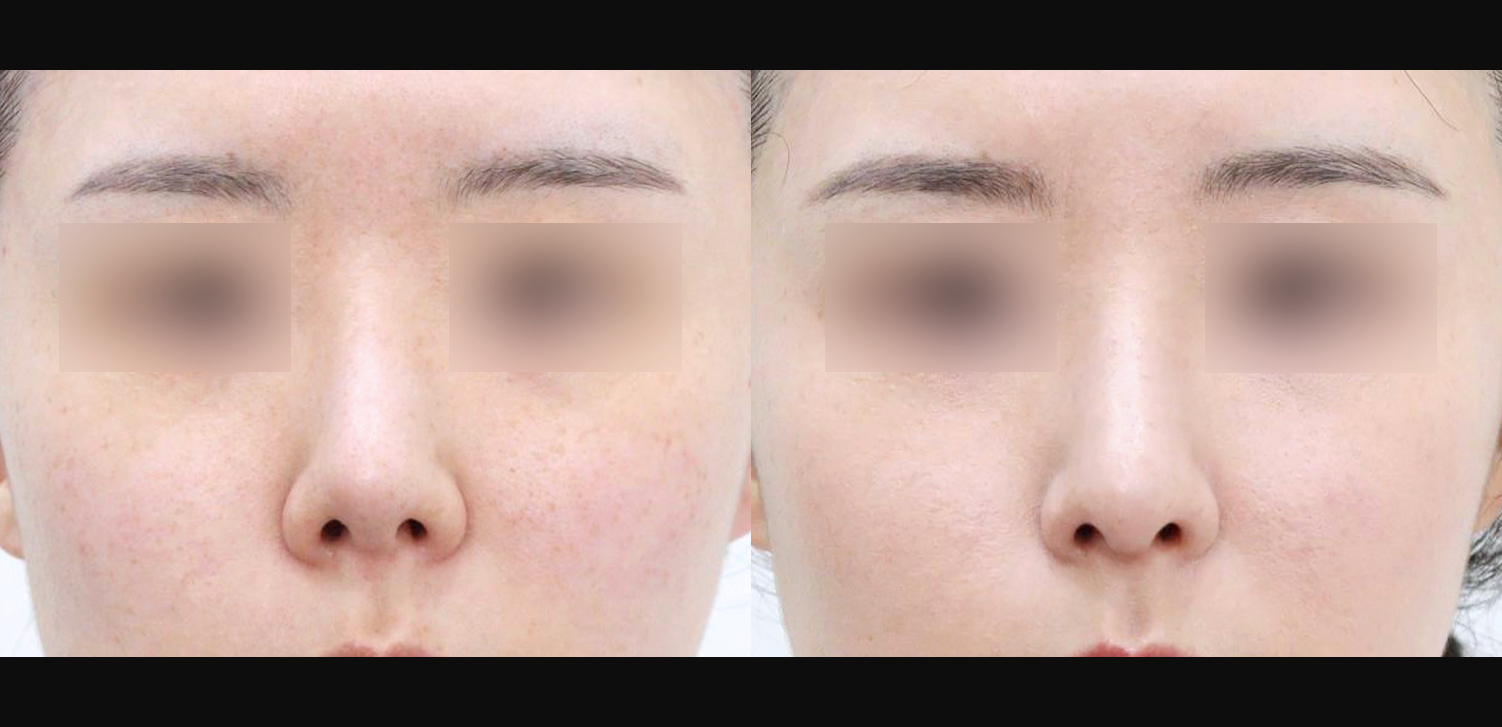 3D 코성형 재수술(자가늑+들창코+복코+인중코)