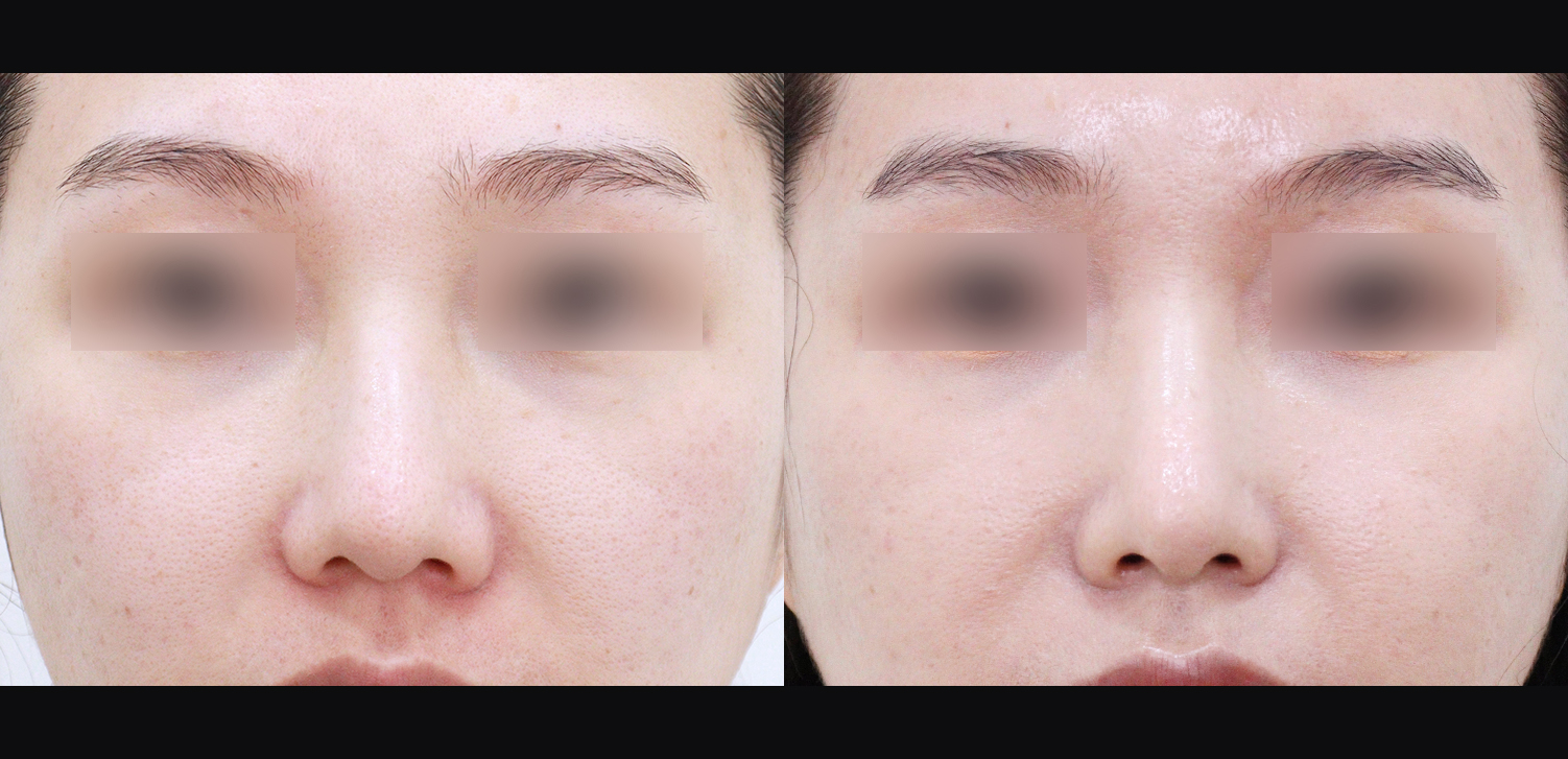 코끝+인중코+매부리+기능코