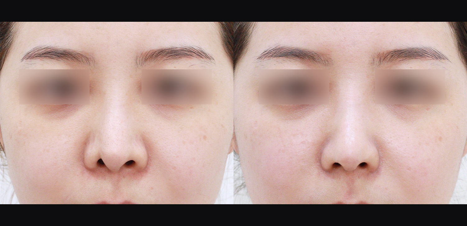 3D 코성형 재수술(콧대+코끝+찝힌코+인중코)