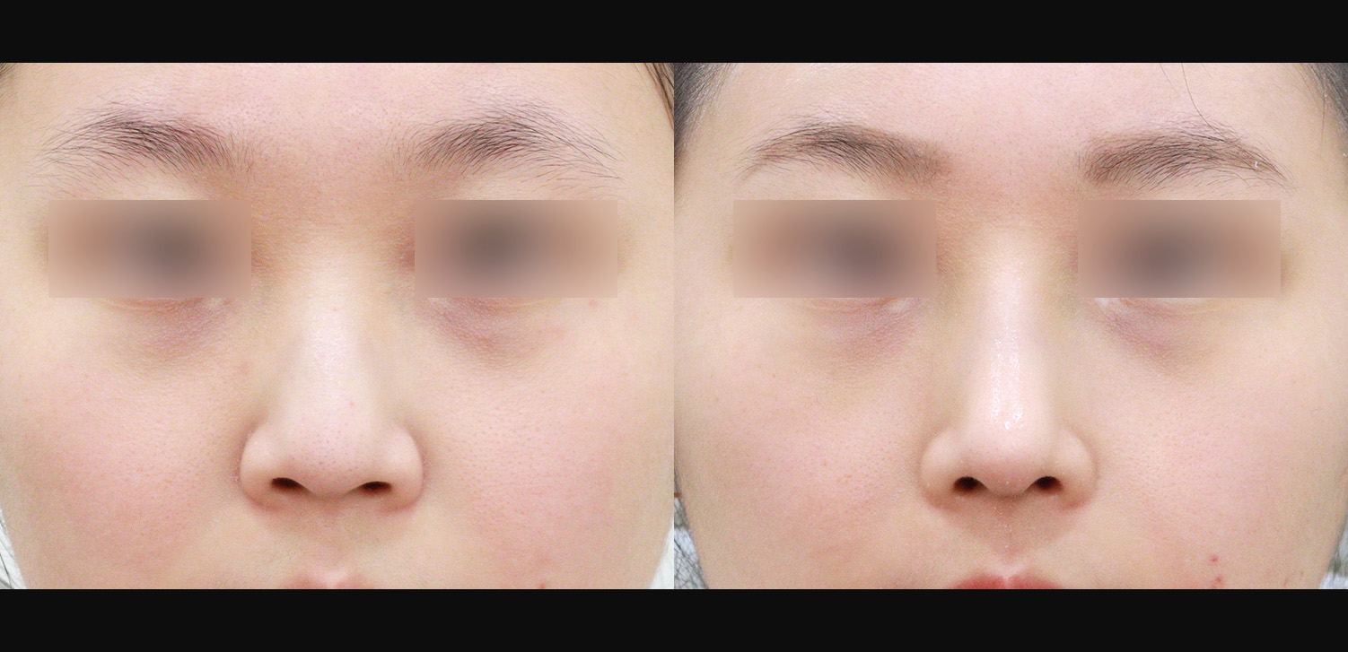 3D코성형(들창코+복코+인중코)