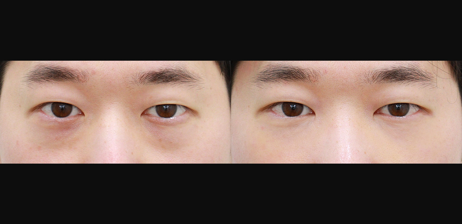 눈밑지방재배치+지방이식(앞광대)
