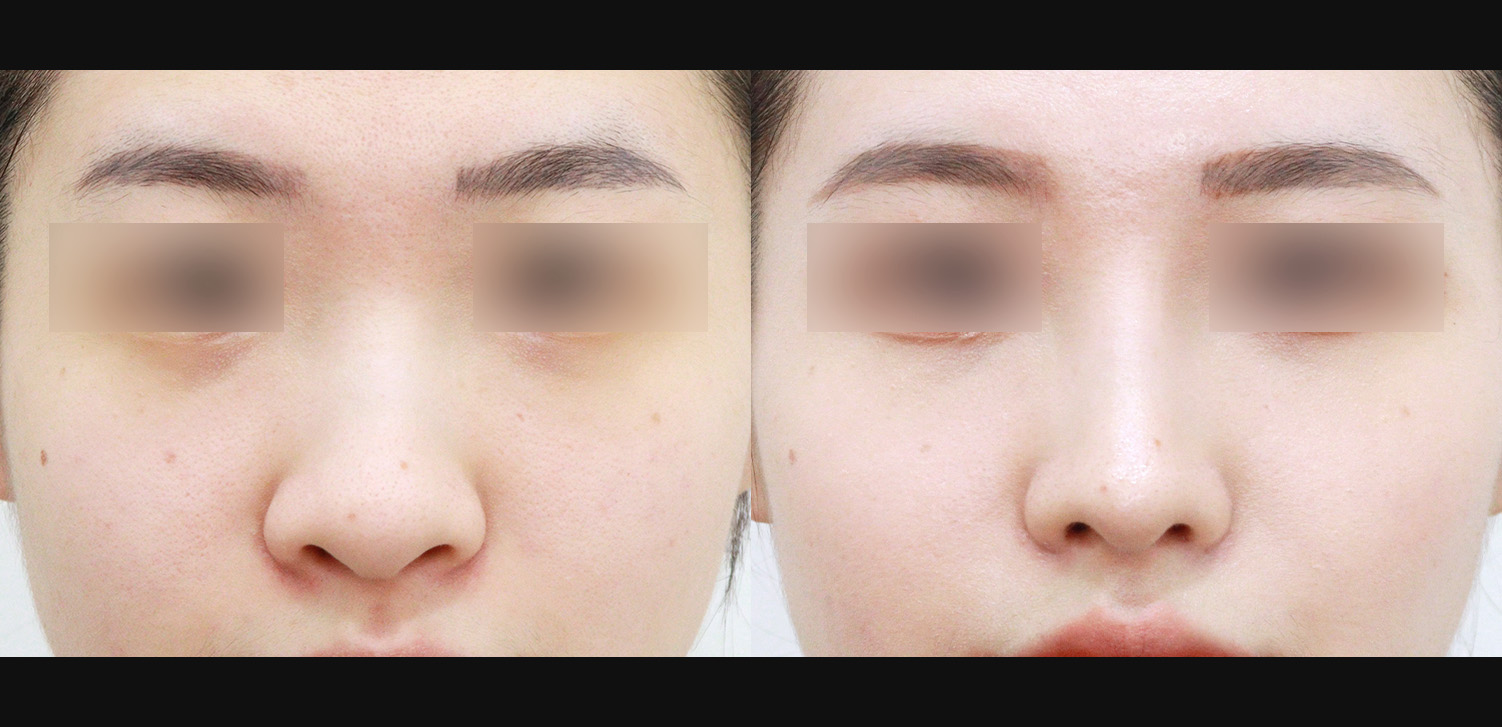3D코성형(복코+비추처짐개선+인중코+콧볼축소)