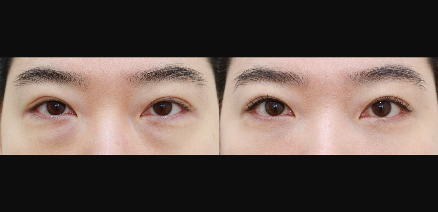 눈밑지방재배치