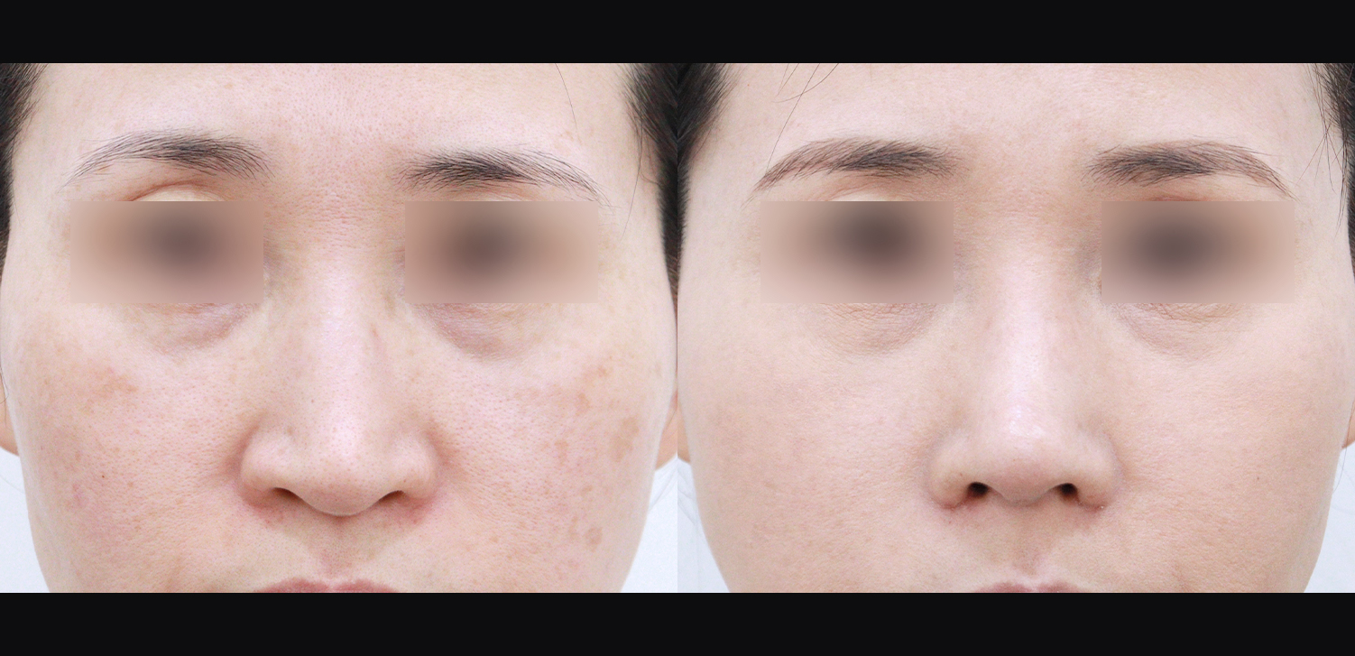 코끝+매부리+인중코+콧볼축소+기능코