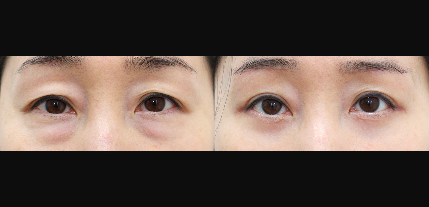 눈썹하거상+하안검+외안각고정