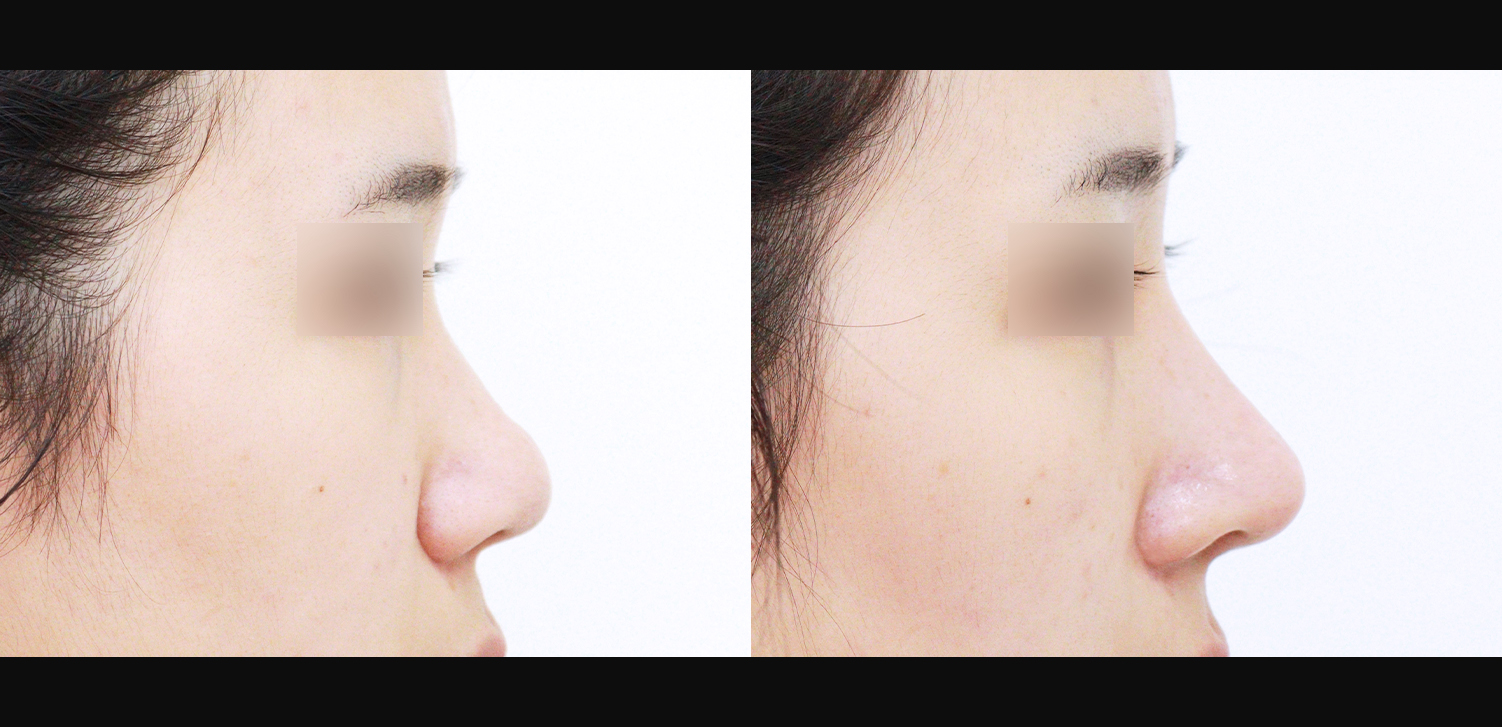 3D 코성형(복코+인중코+콧볼축소)