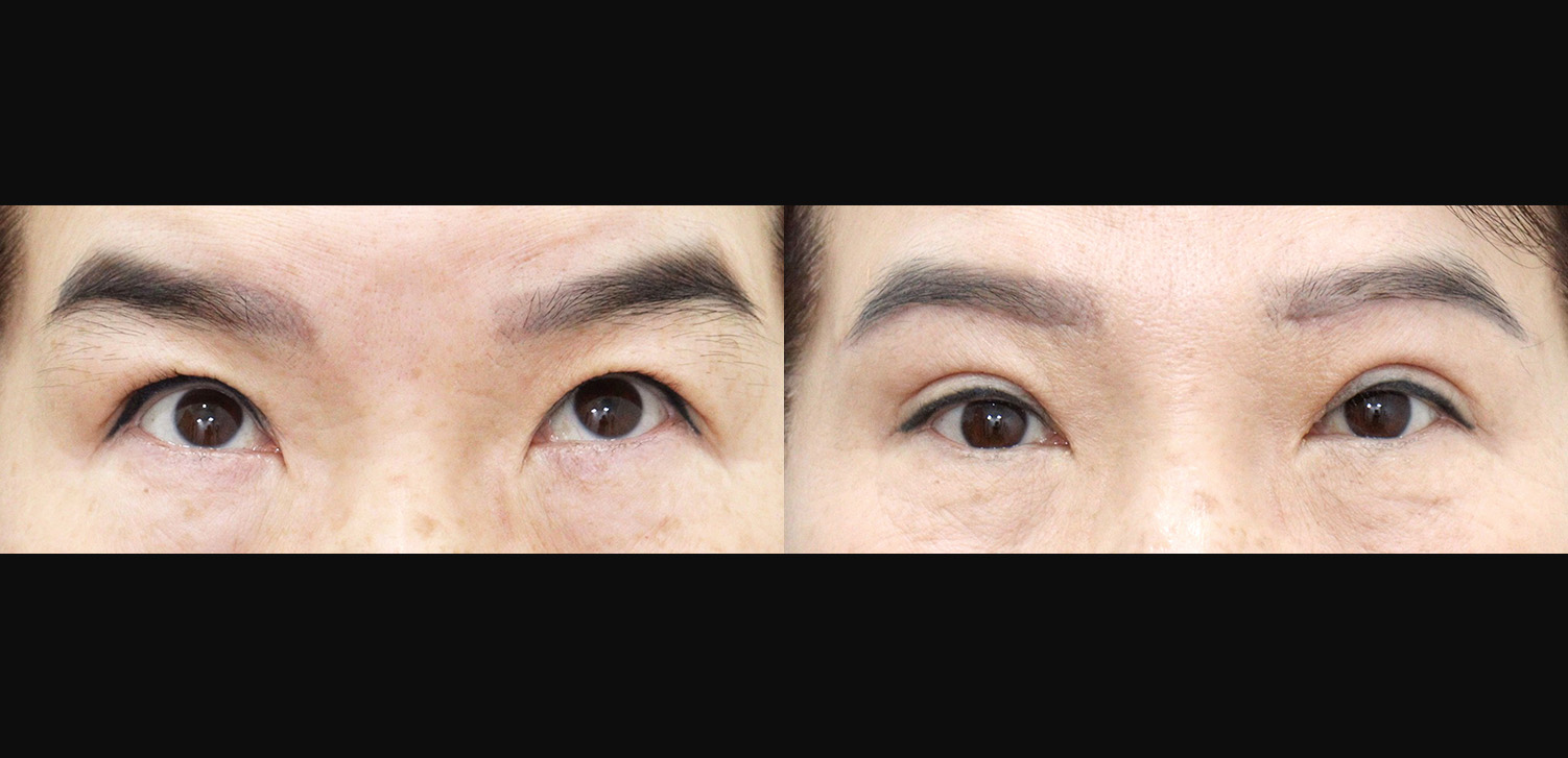 눈썹하거상술+미니거상(이마)