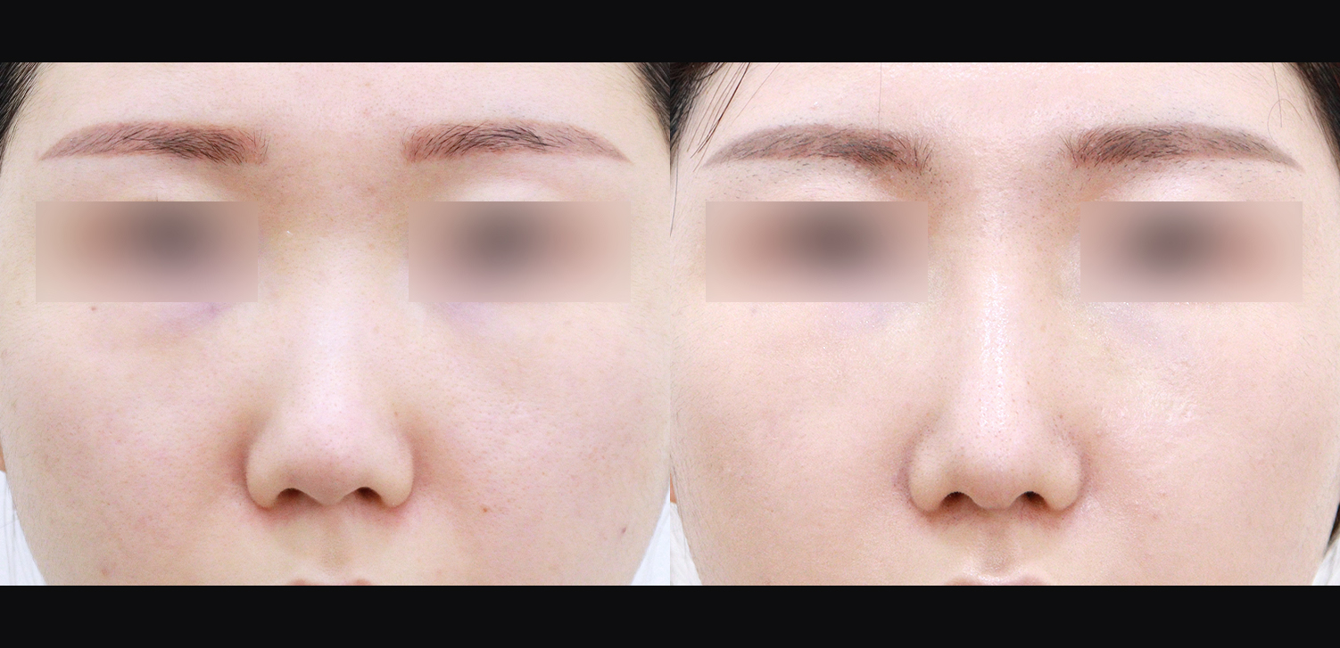 3D 코성형(콧대+코끝+들창코+인중코)