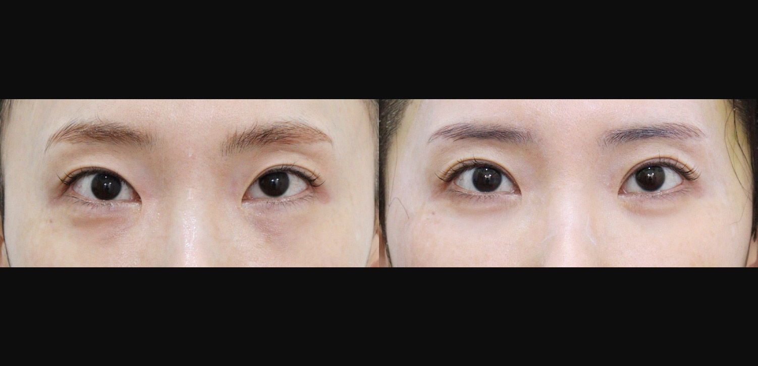 절개  쌍꺼풀+눈위지방재배치+눈밑지방재배치