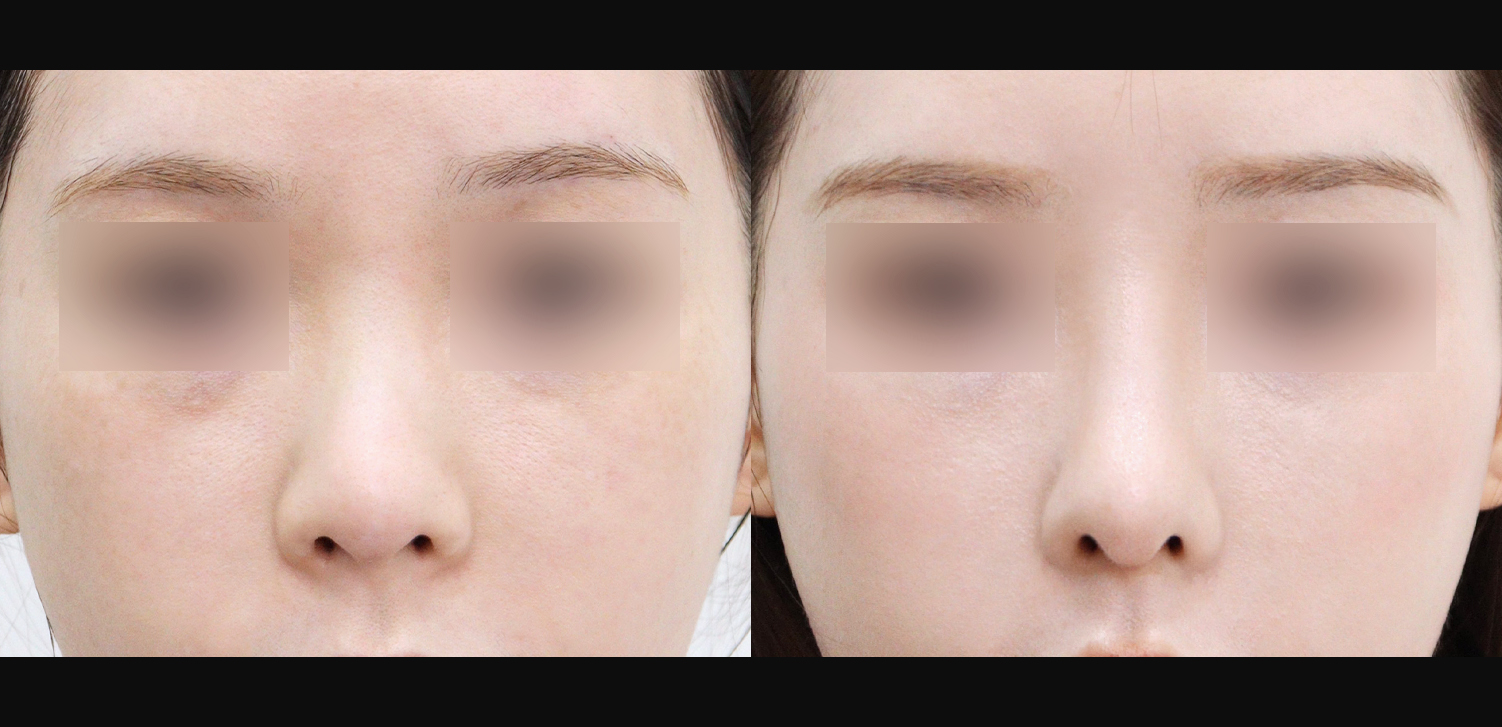 3D 코성형(자가늑+들창코+복코+인중코)